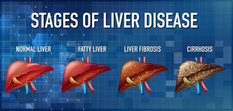 5 liver diseases.